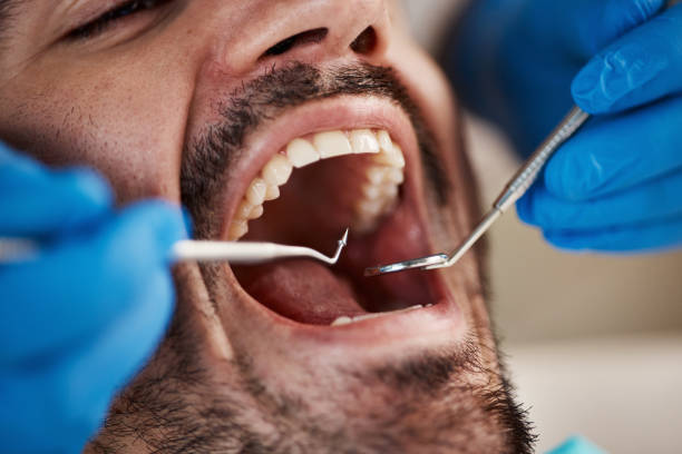 Best Emergency Tooth Extraction in Demopolis, AL